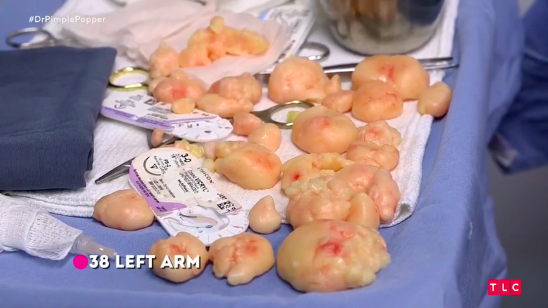 Illustration for article titled Dr. Pimple Popper Removes 68 Lipomas from One Person in Season 2 Premiere